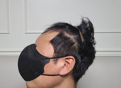 다나성형외과 무삭발비절개 19개월입니다.