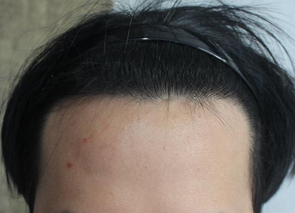 Hanive M-shaped hair transplantation in 12-month final stage of hair transplantation