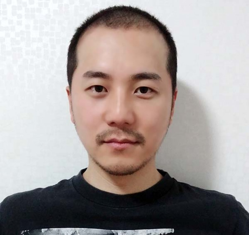 It's been 4 months since I had a non-intersected hair transplant ^^