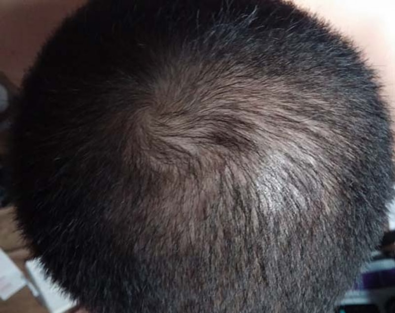 It's been three months of non-cut hair transplants...