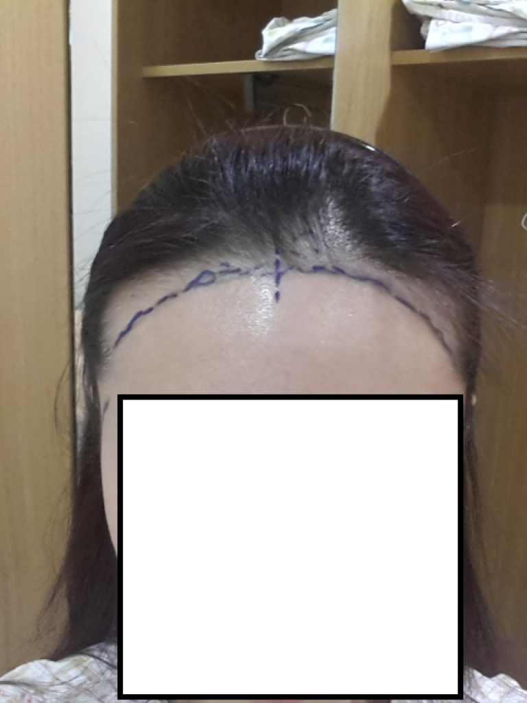 다나 수술 4개월째....나름 만족하네요 ^^