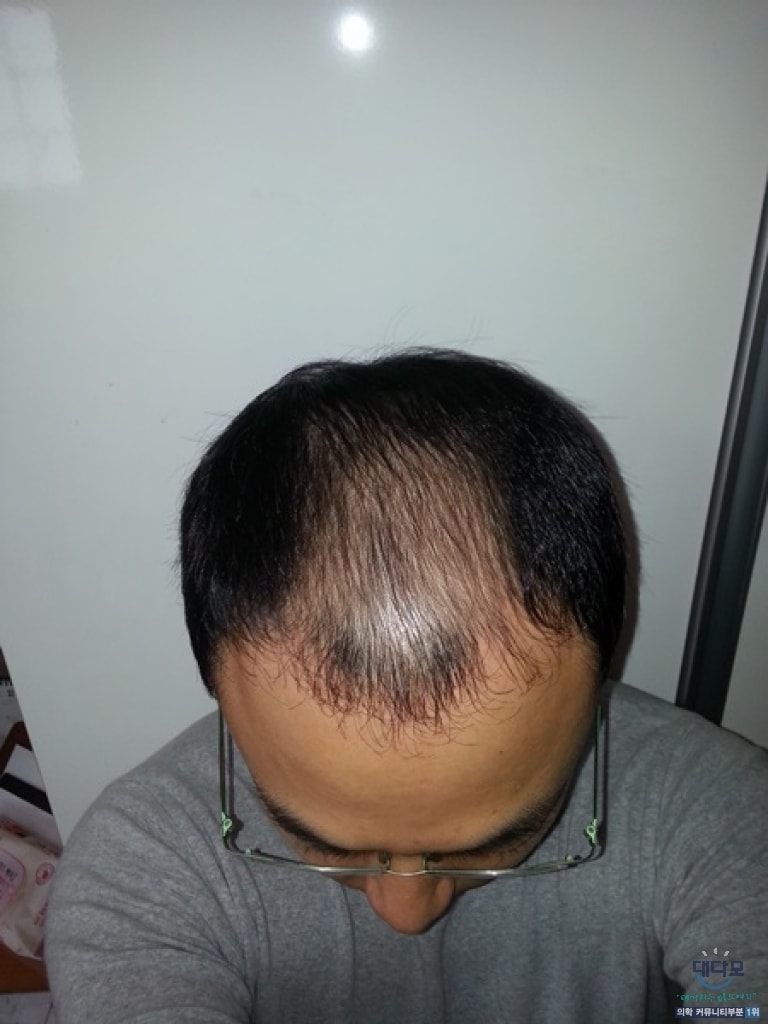 8개월 비절개 3000모낭 다나성형외과 후기입니다