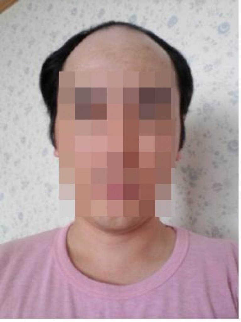 비절개모발이식 5개월차, 암흑기탈출직전...