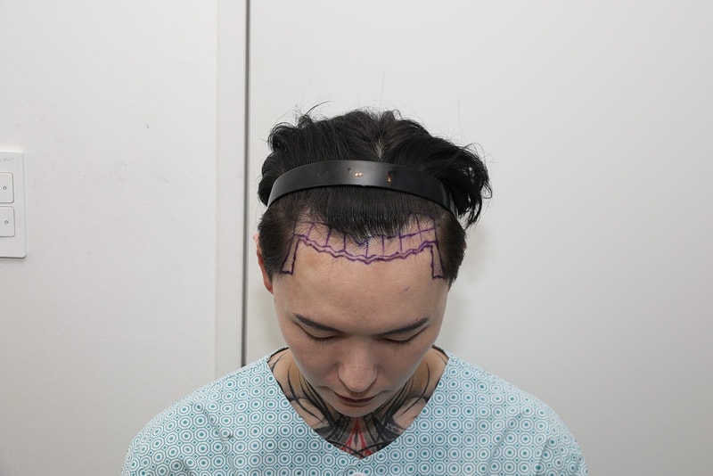 New Hair Seoul branch incision hair transplantation 2000 hair follicles 11 months later