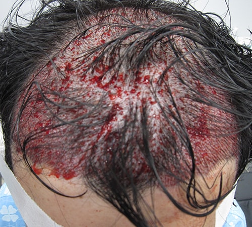 대량이식은 역시 한나이브가 탑인거 같습니다(혼용 5900모 이식)