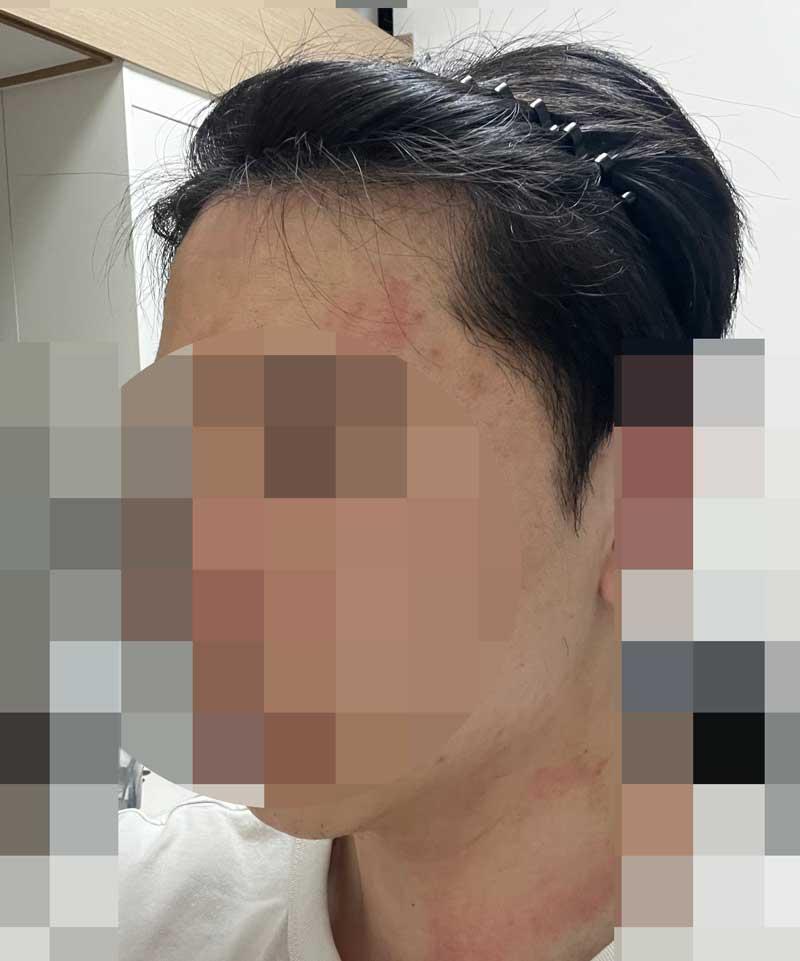 ダナ整形外科無剃髪7ヶ月目！ 一ヶ月の間にディテールがすごいです