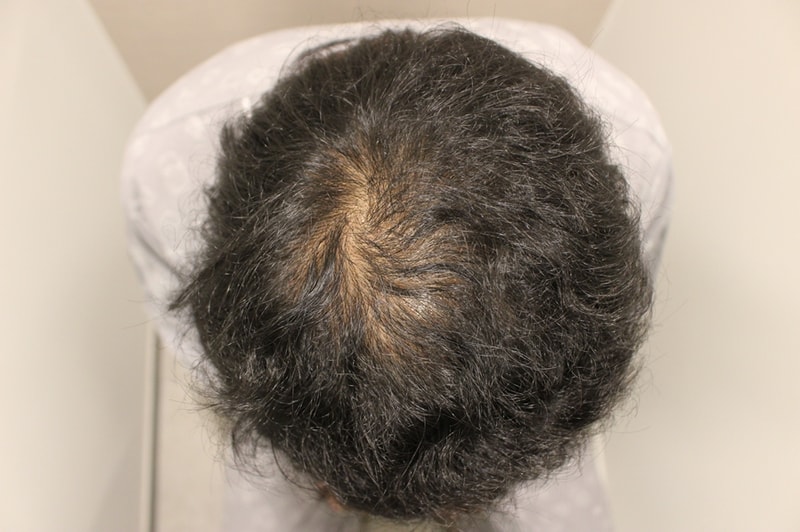 Dr. Charm Gama completes hair transplantation for crown hair loss
