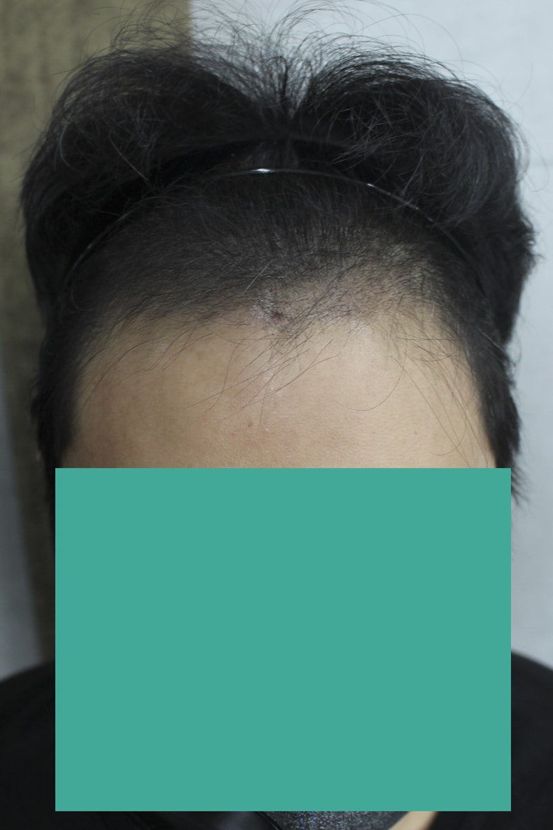 이식하고 두달 괜찮은지 궁금해서 후기 올려봅니다