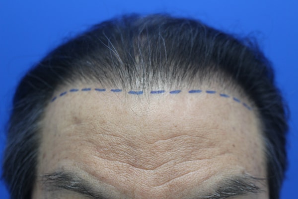 저도 아버지께 모발이식을 해드렸습니다. (비절개 3156모)