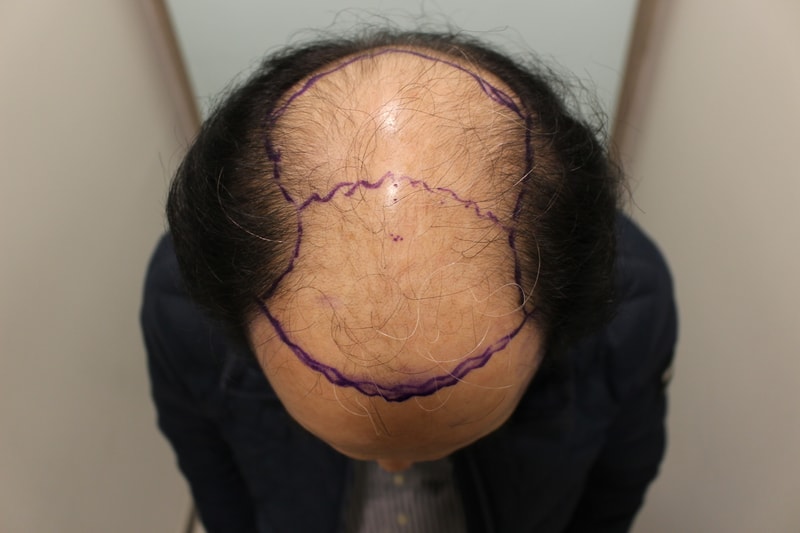 수술전 디자인 1.JPG