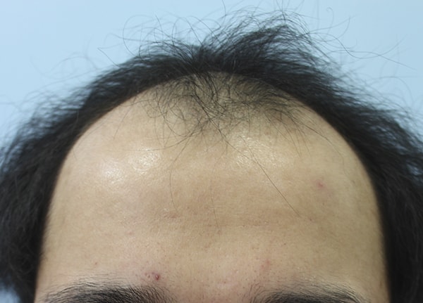 In two years, I reinforced the density and received a hair transplant on the top of my head.