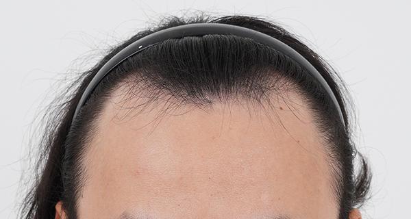 It's an M-shaped hair transplant for 2 weeks.