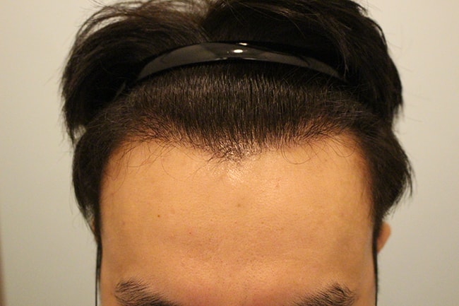 수술후 6개월 5.JPG