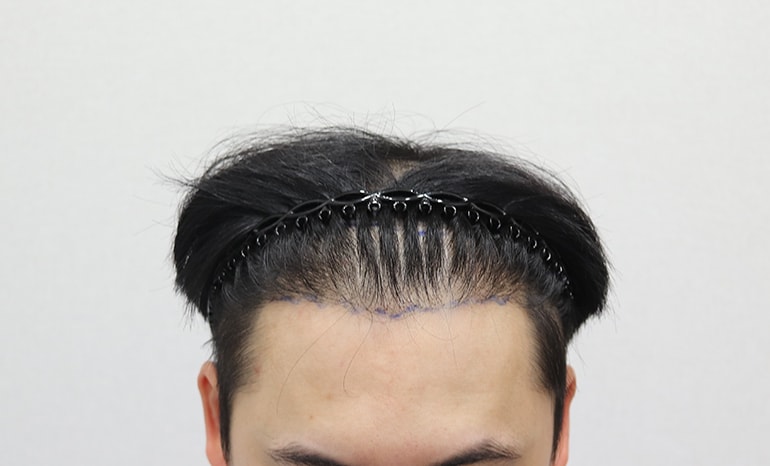 第一次手术失败后 在Moplus重修已经8个月了