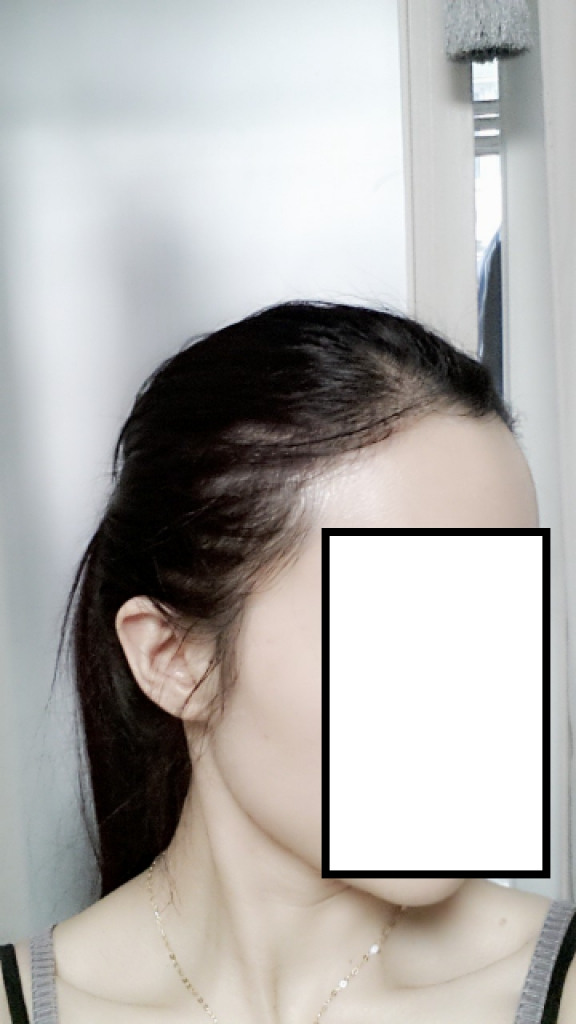 다나에서 헤어라인 3400모 후기에요 ^^