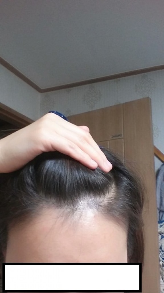 ヘアライン1800モダナ整形外科2ヶ月レビュー~