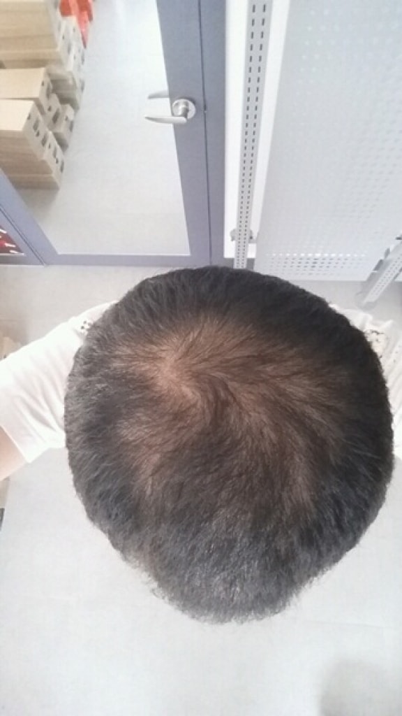 Non-cut hair transplant 3000 hair follicles 2 months...