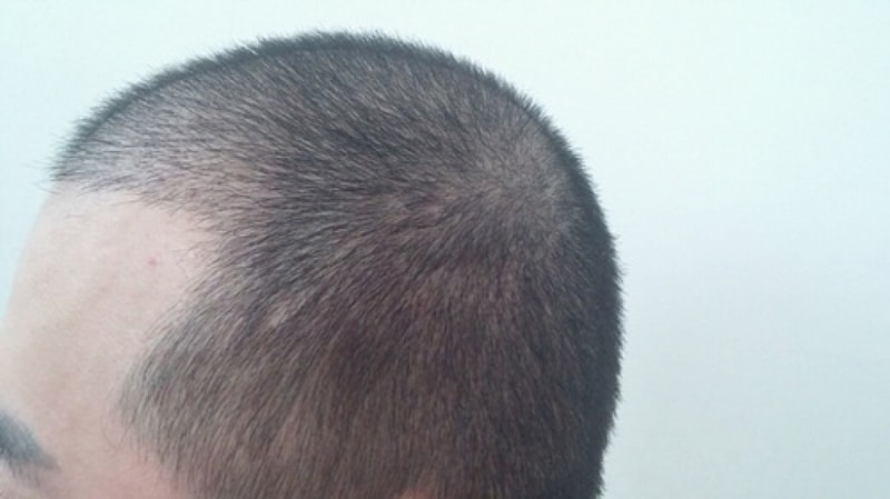 Non-cut hair transplant 3000 hair follicle Dana is a month old review ^^