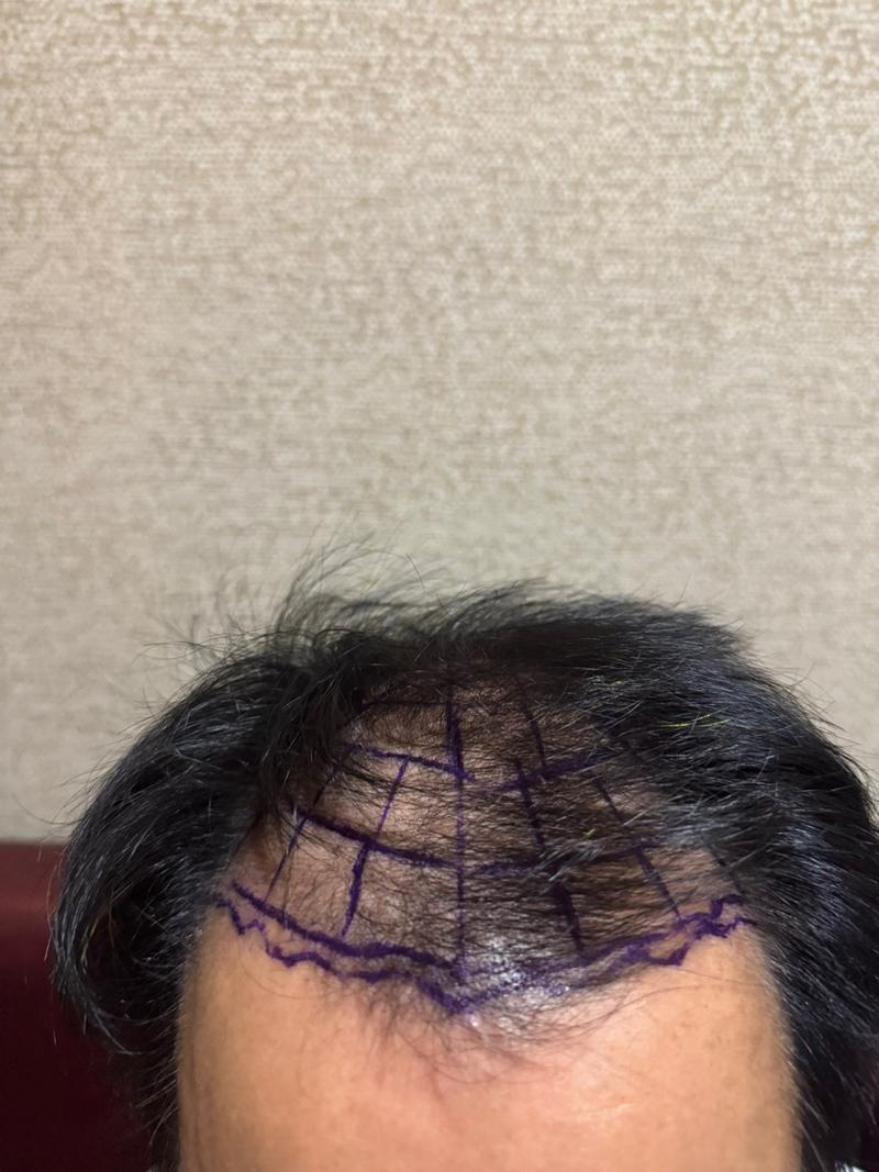 New Hair Seoul branch incision hair transplant 2500 hair follicles (5,000 hair) 7th day review