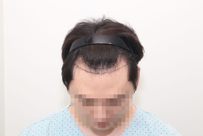 뉴헤어모발성형외과 모발이식 1400모낭 1년 후기