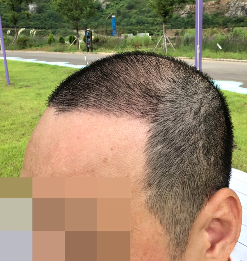 다나성형외과 대량탈모 [비절개이식 7000모 4개월]