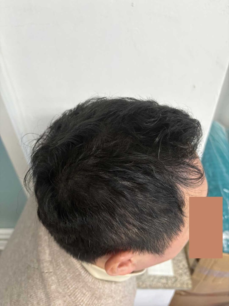 다나성형외과 대량모발이식 1년같은 7개월~~