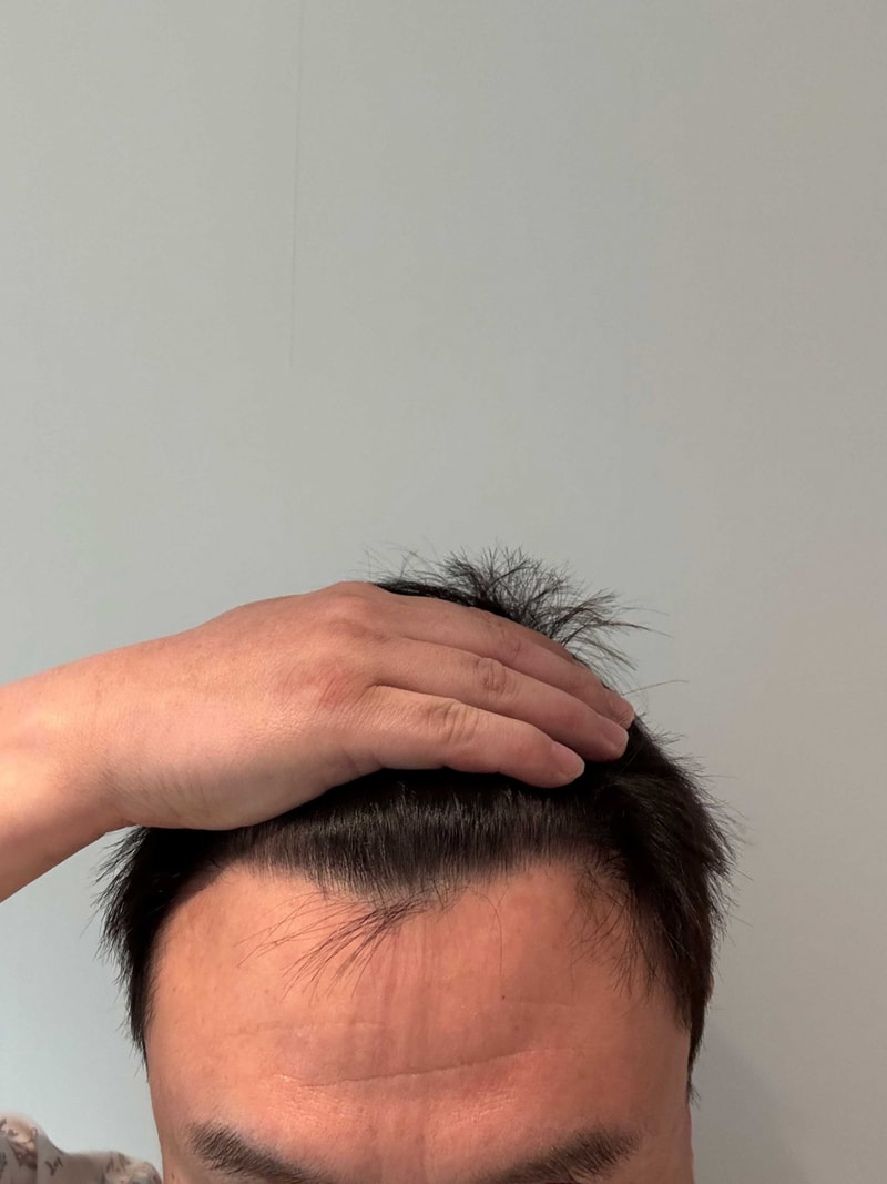 다나성형외과 비절개모발이식 13개월차