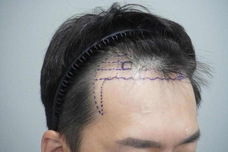 Rep. Grow (formerly New Hair Busan) The first year of hair transplantation is written in the review. (Director Jang Tae-ho, 3000mo)