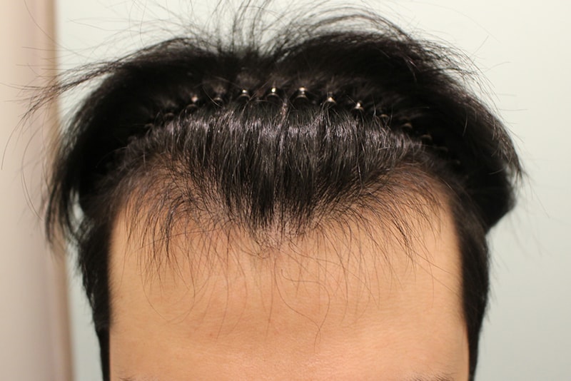 After 7 months of close and meticulous hairline correction!