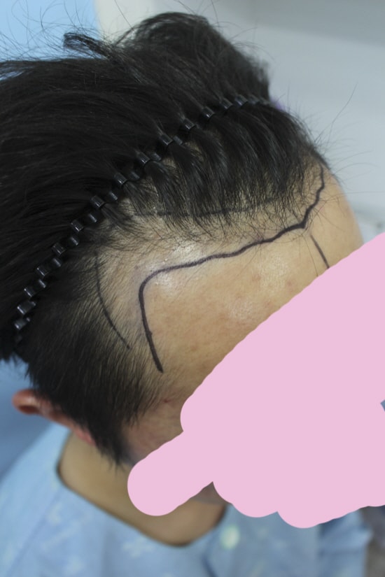 절개로 수술했고 사진이 와서 올려봅니다