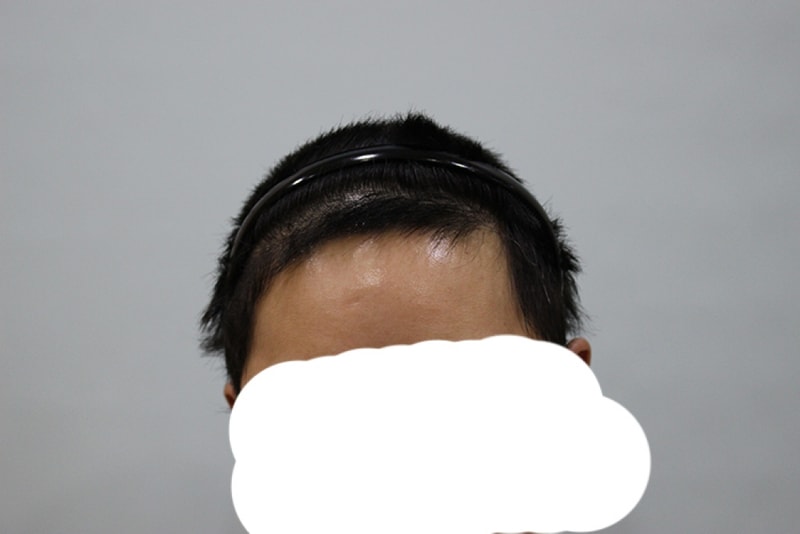 수술후6개월.jpg