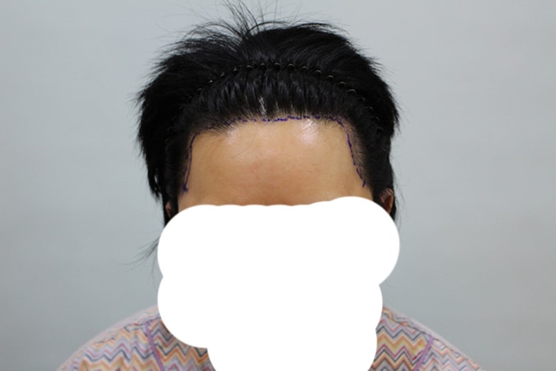 Dr. M.A. Hairline, a non-cut hair transplant
