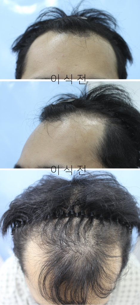 절개 3500모 헤어라인+전두부 이식했습니다
