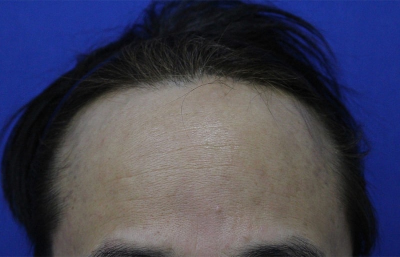 After much consideration, I had a 3730-mo incision