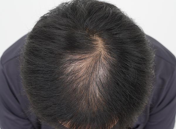 頭頂部3500本移植成功しました