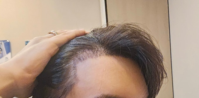 5. 병원에서 샴푸받고 찍어봤네요 ㅎㅎ.jpg