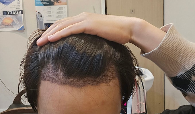 4. 2주차부터 셀프 지문샴푸해서 많이 빠지고 있습니다.jpg