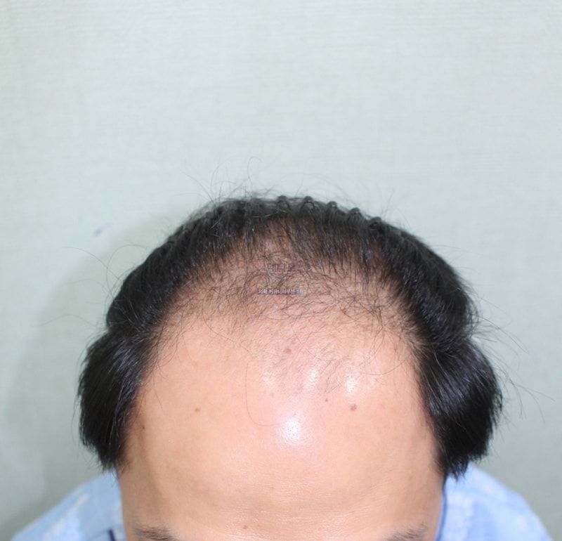 It's been three months since my transplant Please give me some advice
