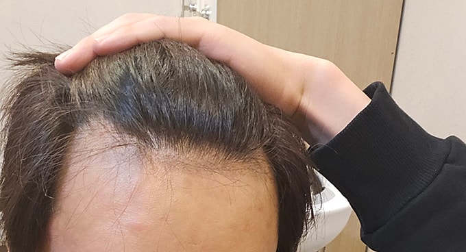 3. 어제 메조주사맞고 찍은사진입니다 암흑기 엄청납니다 다 털린 상태.jpg