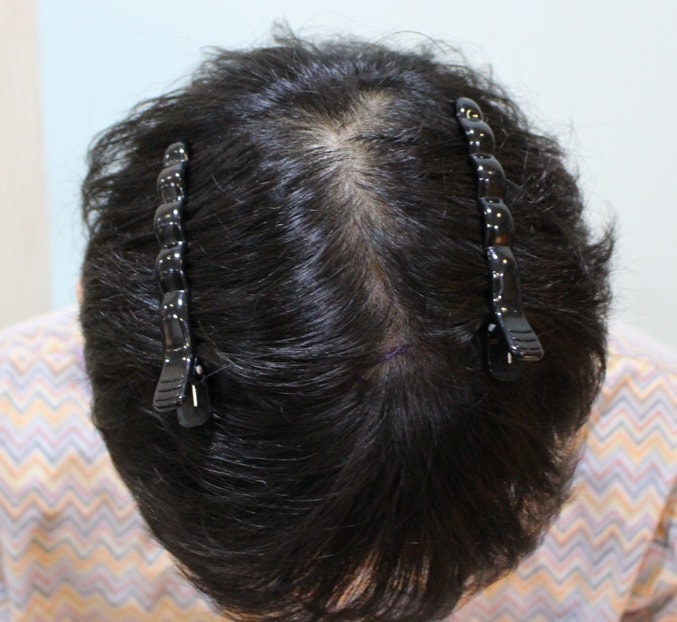 Hair transplantation to the left and right of the part and front of the kiln