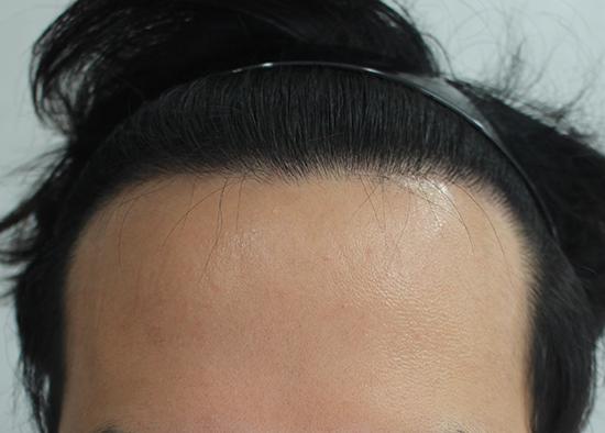 8th Month of Hanive M-shaped Hair Transplantation