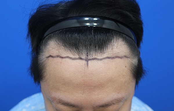 M자 모발이식!! 비절개 3200모 직후 입니다!