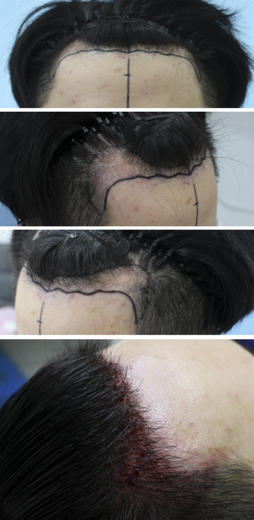 In a few weeks, it's been a year since the transplant
