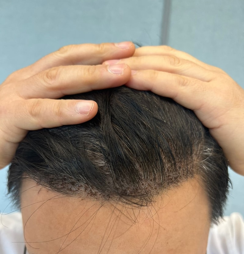 Dana再手术后记 萝卜削发确实很好