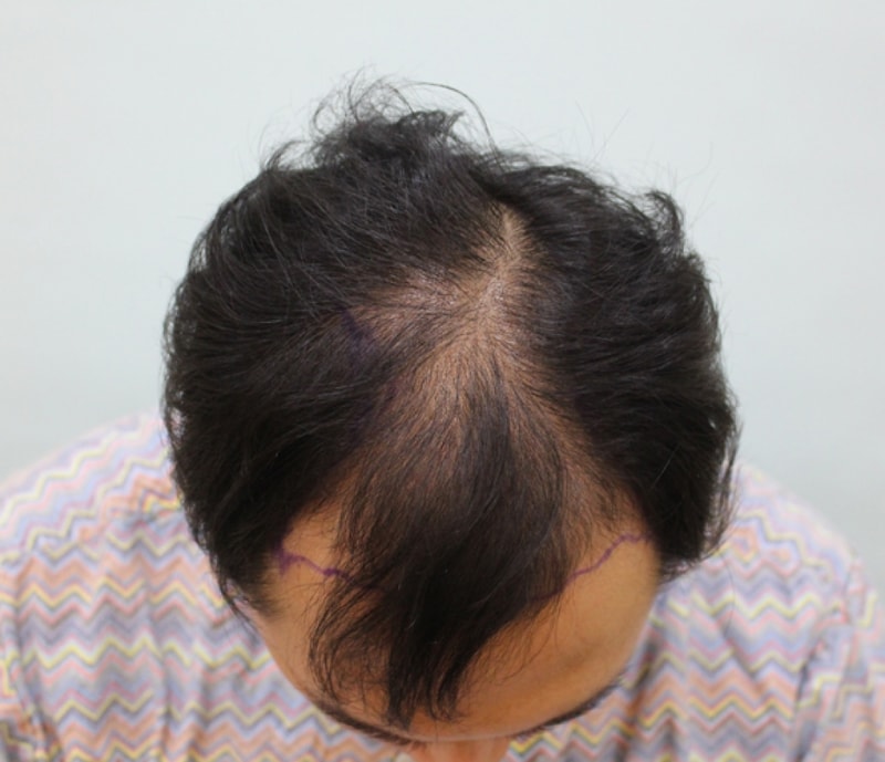 真医生切开4500毛，差5个月