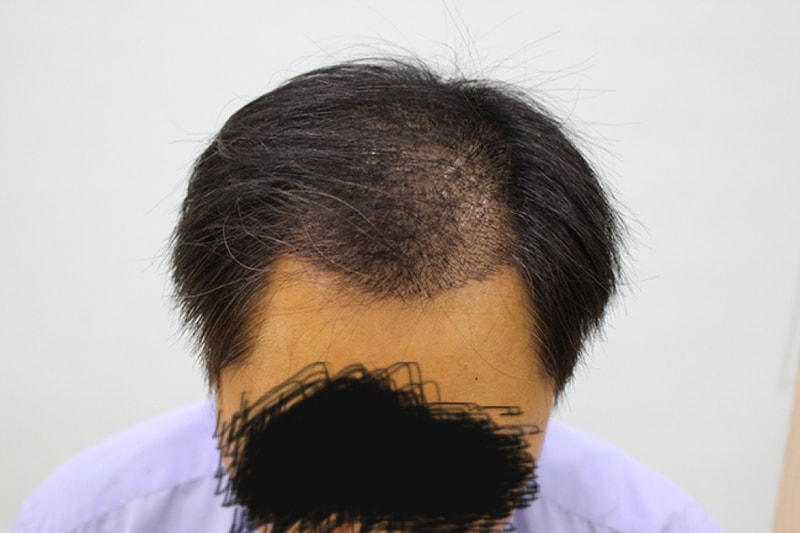 수술후10일(3).JPG