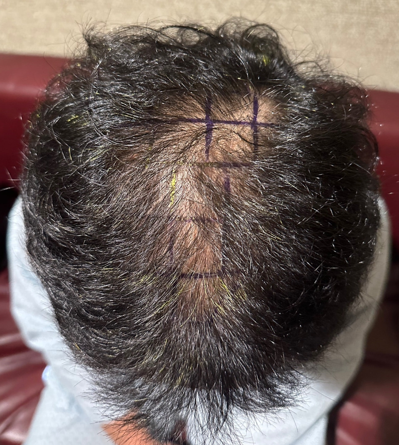 New Hair Hair Plastic Surgery Head Transplantation 2000 Hair follicles 7th Day Late