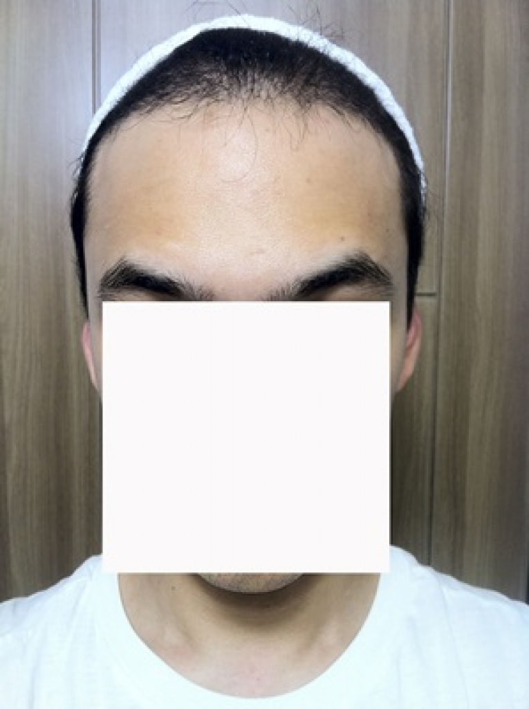 M자 수술 4개월 !! 확인부탁!!