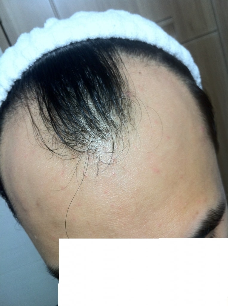 수술전정면.JPG