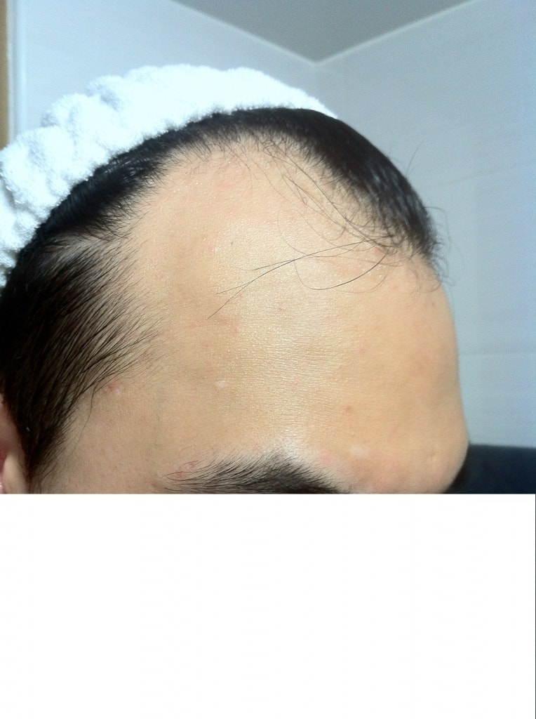 수술 후 10일 차 실밥 제거했습니다.